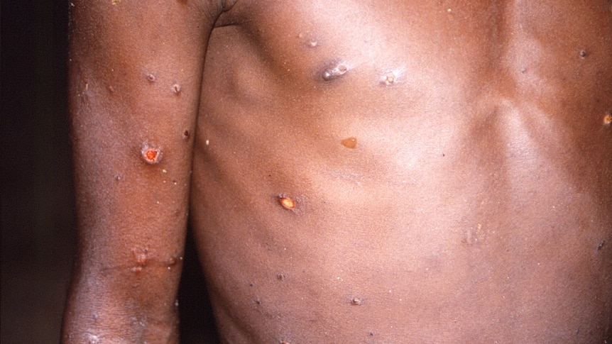 The arms and torso of a patient with skin lesions