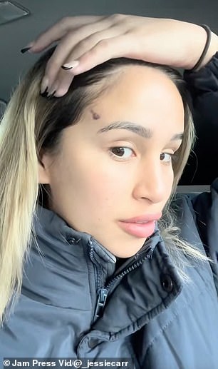 An Australian woman who went viral after her 'fox eye' procedure went wrong and left her with 'horns' has revealed her issues are ongoing with her forehead now turning black